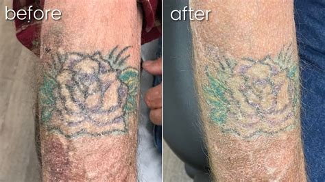 Effective Tattoo Removal Services in Bakersfield - Say Goodbye to Ink